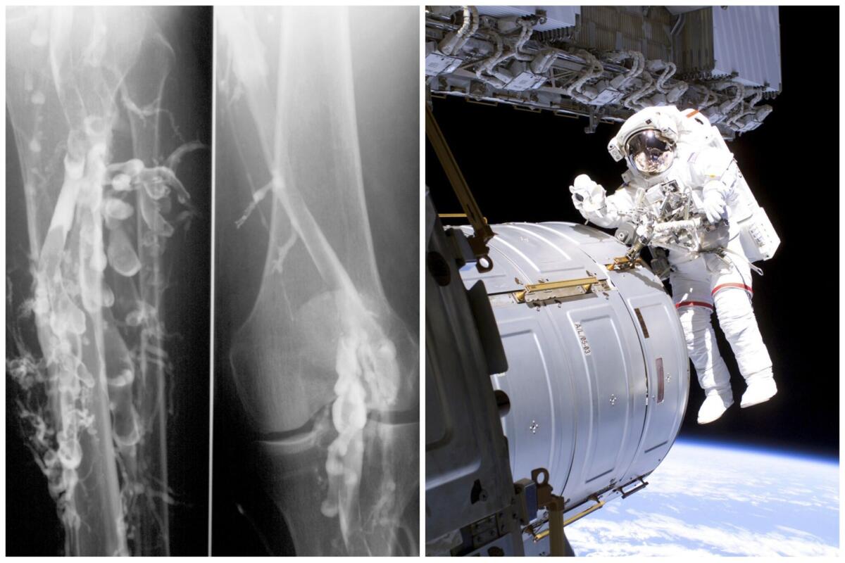 Astronauta in orbita affetto da trombosi: curato con telemedicina - 