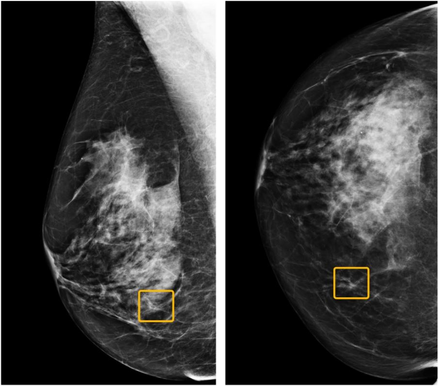 Esempio di massa maligna con microcalcificazioni rilevata dall'AI e non dai radiologi