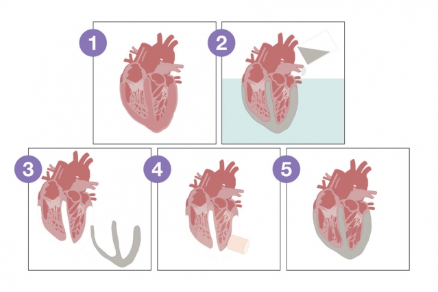 Un muscolo cardiaco preservato (1) viene rimosso e sostituito con una matrice sintetica morbida (2). Le due strutture (tessuto cardiaco interno e matrice sintetica) (3) sono legate mediante un adesivo di nuova concezione, TissueSil (4). Il pezzo risultant