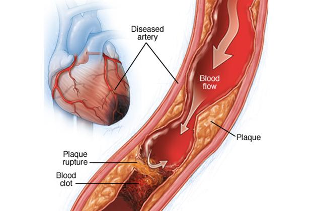 Cuore affetto da cardiopatia ischemica. Credits forumsalute.it