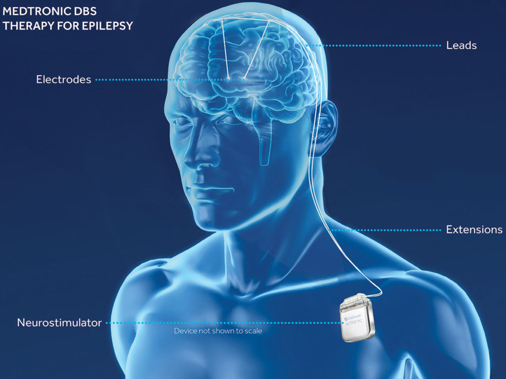 Il sistema DBS di Medtronic è oggi comunemente usato per trattare i sintomi del movimento del morbo di Parkinson.
