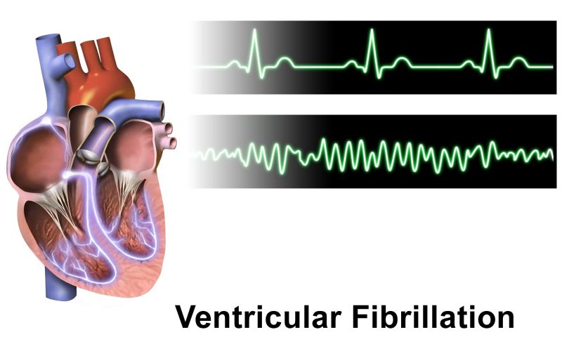 Rappresentazione semplificata della differenza tra l'ECG del ritmo cardiaco normale e quello che si registra durante la fibrillazione ventricolare. Credits: BruceBlaus