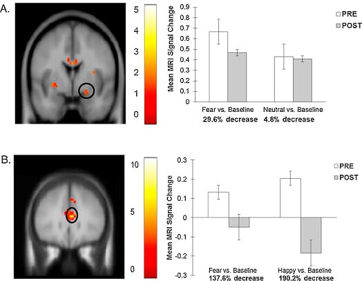 Risposta dell’amigdala (A) e della corteccia cingolare anteriore (B) prima e dopo il trattamento(Tratto dall'American Journal of Psychiatry)