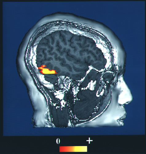 Attivazione del giro fusiforme durante un compito di riconoscimento facciale, rilevata attraverso risonanza magnetica funzionale (fMRI)Credits: NIH