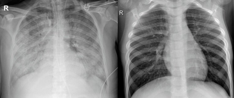 Due radiografie di soggetto Covid-19 (sinistra) e soggetto sano (destra). Credits: Aisent.io.