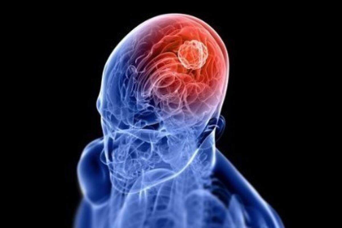 Malattia di Huntington: indizi già 24 anni prima dell'insorgere dei sintomi - researchitaly.it