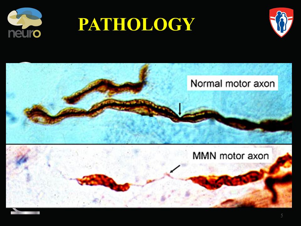 PATHOLOGY MMN Multifocal Motor Neuropathy