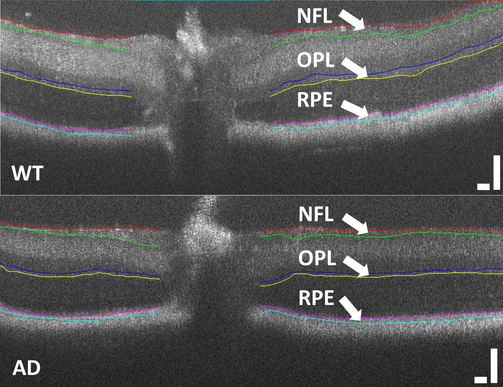 Un confronto dello spessore degli strati retinici tra topi selvatici e sani (in alto) e topi allevati da una selezione genetica per mostrare i sintomi della malattia di Alzheimer (in basso). Lo strato superiore della retina dei topi con la malattia di Alz
