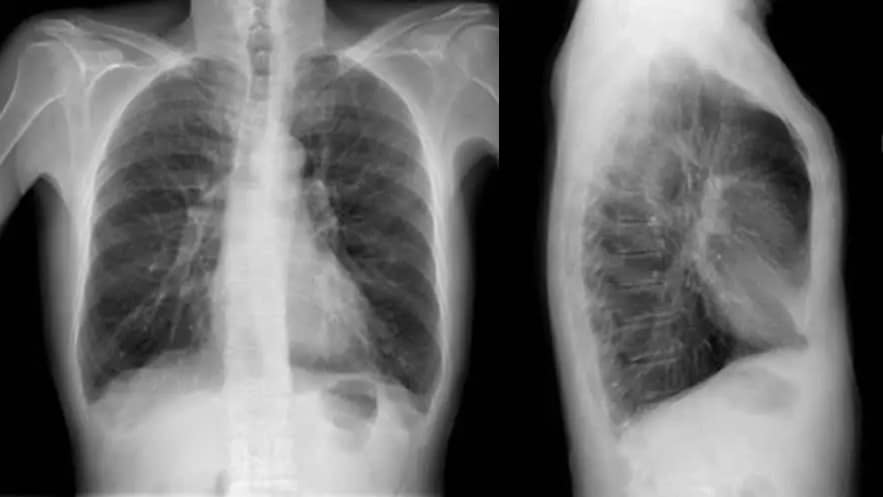Radiografia di un enfisema, crediti: pneumologo-ballor.it
