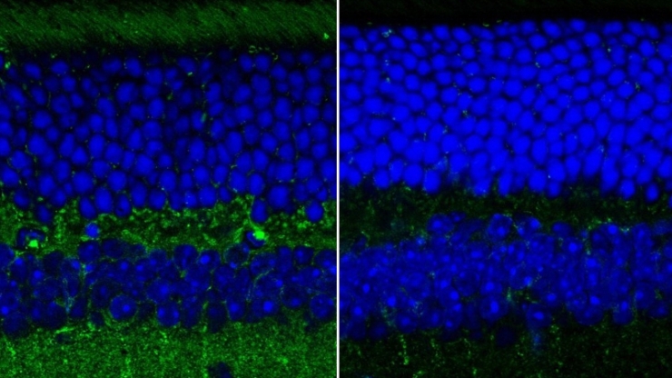 Un'immagine a fluorescenza da un microscopio confocale degli strati retinici di topi selvatici e sani (a destra) e topi allevati da una selezione genetica per mostrare i sintomi della malattia di Alzheimer (a sinistra). Il verde rappresenta i depositi di 