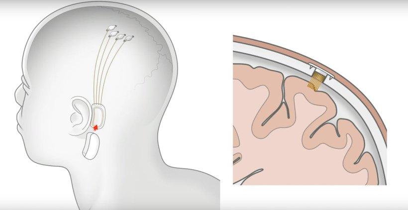 Posizione dei chip. Credits: Neuralink