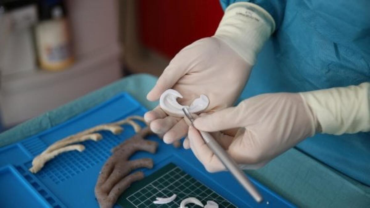 Napoli, bambina riacquista l'udito grazie alla ricostruzione 3D dell'osso temporale - napoli.repubblica.it