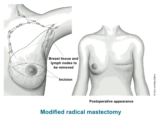 Una mastectomia radicale modificata combina una semplice mastectomia con la rimozione dei linfonodi sotto il braccio (chiamata dissezione linfonodale ascellare). Credits: Sam and Amy Collins