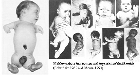 Gli effetti della Talidomide, crediti: Wikipedia
