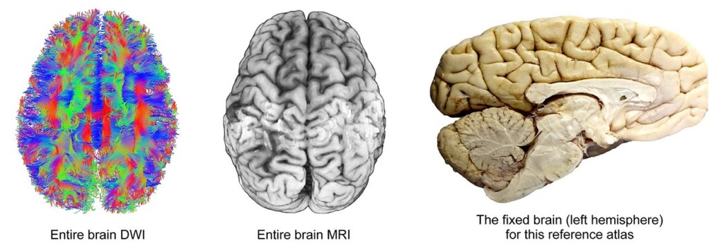 Queste sono delle immagini del cervello riprese con risonanza magnetica di diffusione (immagine a sinistra) e con risonanza magnetica (immagine al centro). A destra troviamo una foto dell'emisfero cerebrale sinistro. Credits: Wiley Periodicals