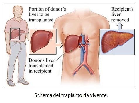 Trapianto di fegato da vivente