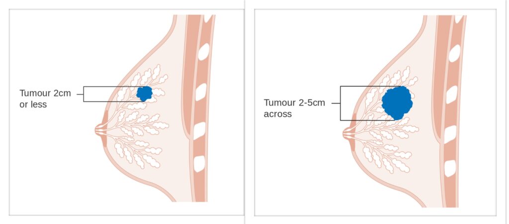 Tumore allo stadio 1 e 2. Credits:  Cancer Research UK