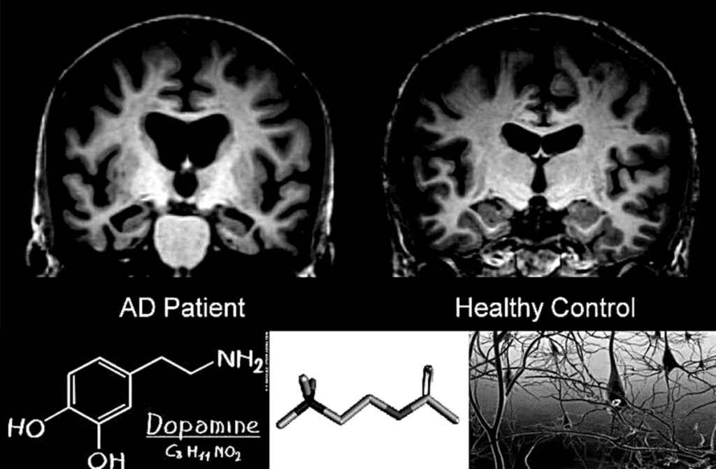 A sinistra paziente affetto da Alzheimer, a destra soggetto sano. Credits: medicomunicare.it
