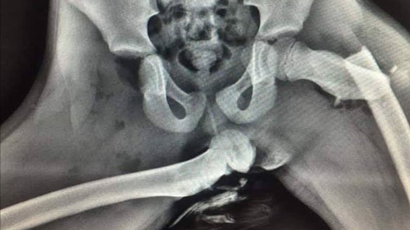 La radiografia a raggi X di una persona che aveva i piedi sul cruscotto