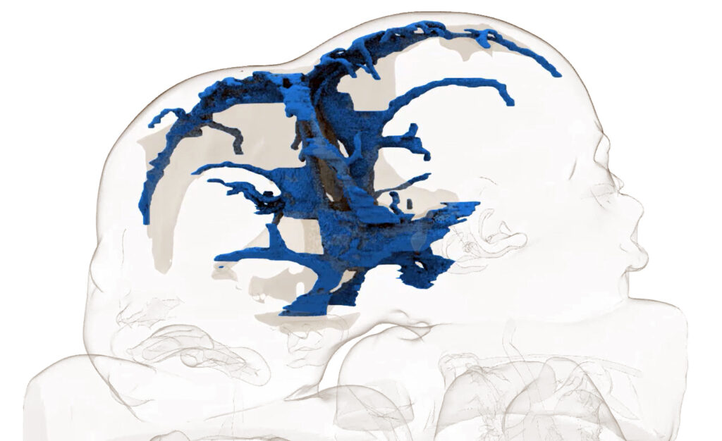 Visualizzazione anatomica dell'anatomia delle due gemelle siamesi.Credits: Ufficio stampa Ospedale Bambino Gesù