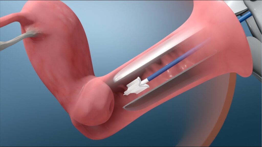 Pap test - credits: youtube.com