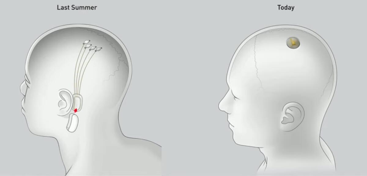 Neuralink, l'aggiornamento di agosto 2020 e la ricerca di nuovi collaboratori - 
