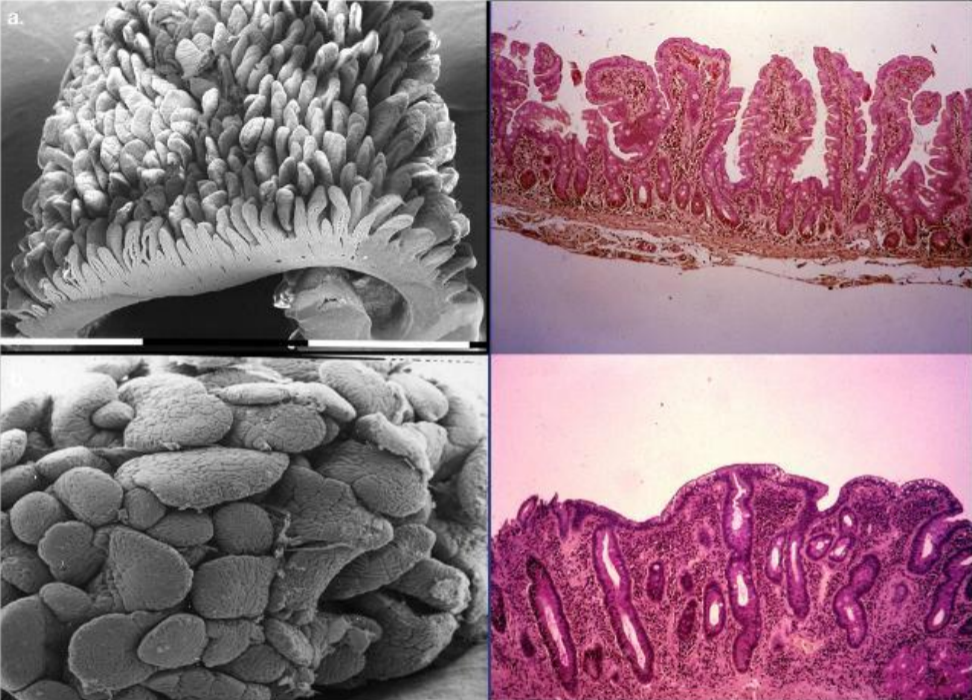 Biopsie intestinali viste al microscopioelettronico a scansione (a sinistra) e almicroscopio ottico (a destra). In alto: mucosacostituita da villi normali. In basso: mucosa di un paziente affetto da malattia celiaca convilli piatti, cripte ipertrofiche e 