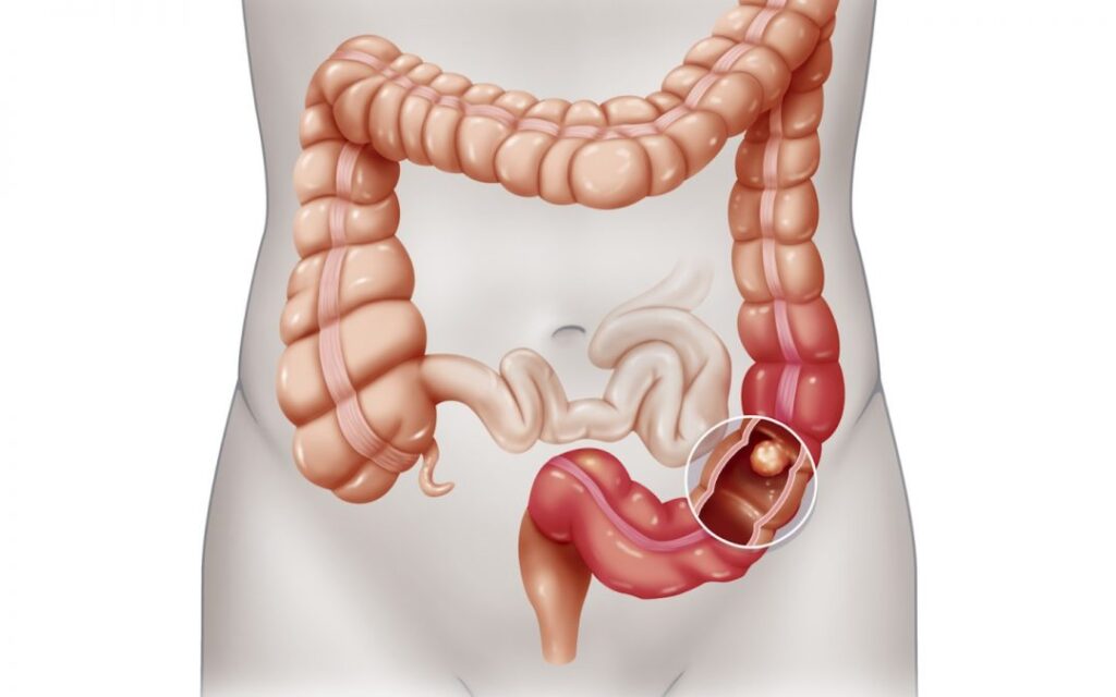 Cancro del colon-rettoCredits: e-oncology