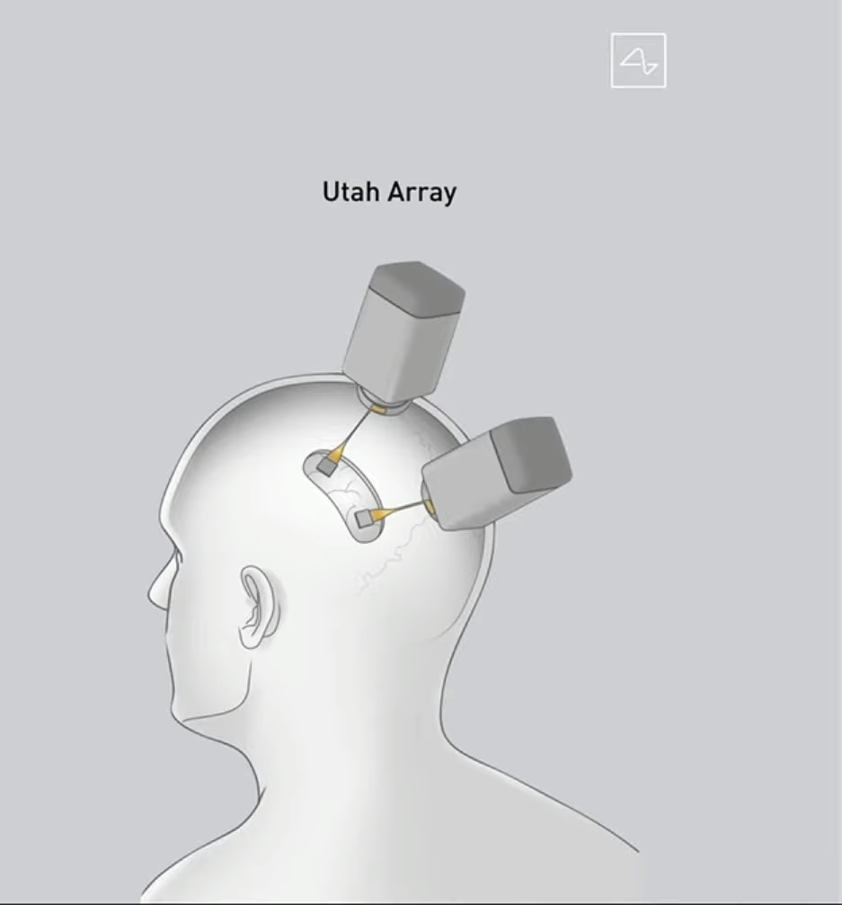 Uno schema dello Utah Array. Sono visibilile scatole molto ingombranti poste sopra alla testa del soggetto. Credits: Neuralink