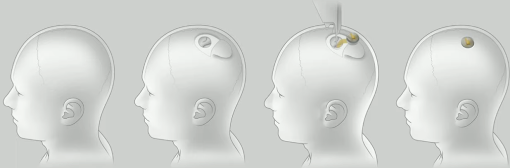 Come avviene l'impianto di Neuralink