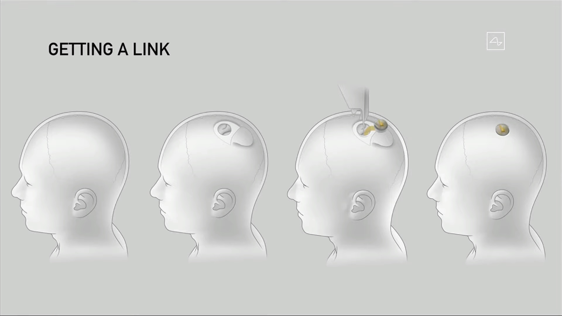 I passaggi effettuati dal robot chirurgico per l'impianto del dispositivo. Credits: Neuralink