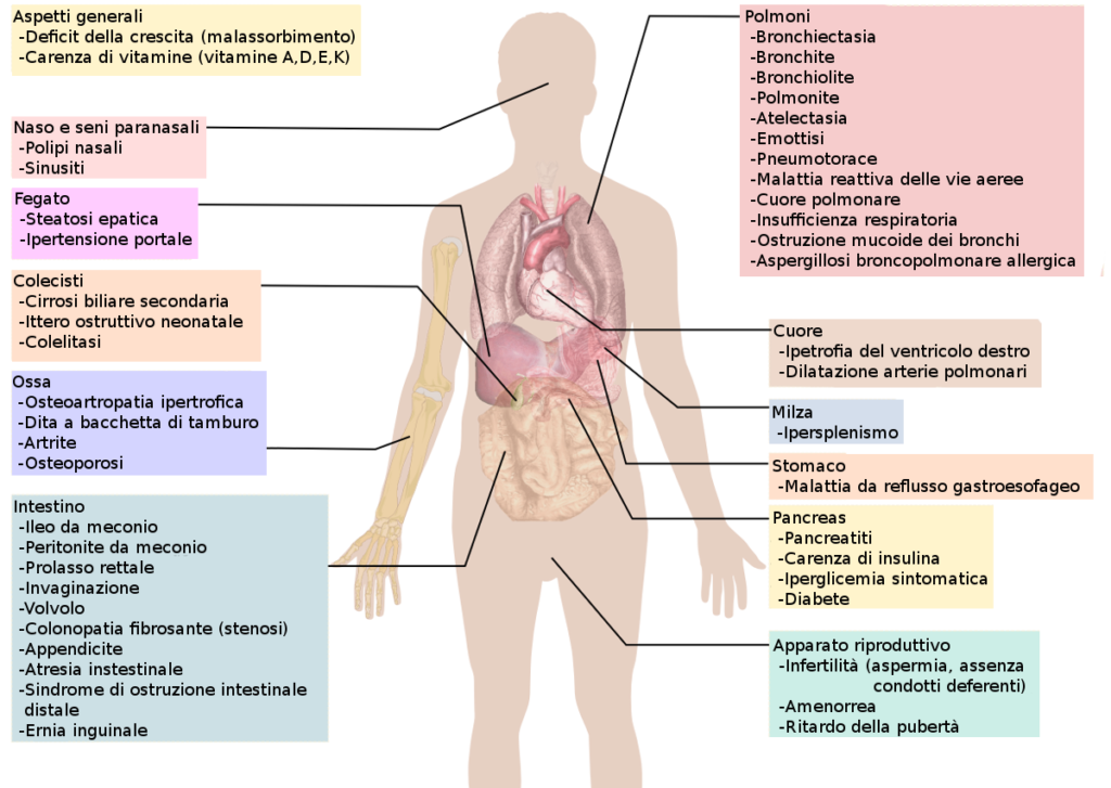 Segni e sintomi della fibrosi cistica. Credits: Wikipedia