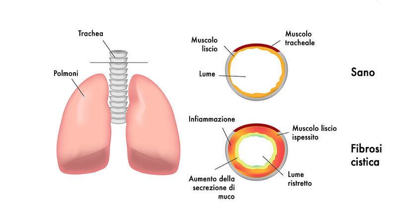 Schema di una sezione della trachea: viene evidenziata la differenza tra il lume della trachea del soggetto sano e quello del soggetto affetto da fibrosi cistica. Credits: doveecomemicuro.it