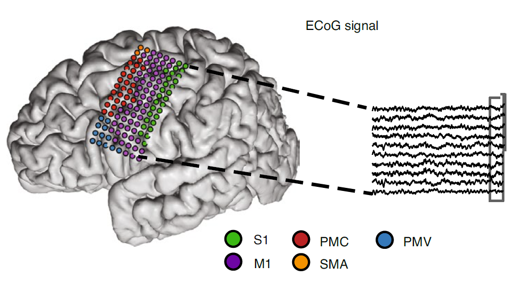 Illustrazione degli elettrodi ECoG (colorati in base alla regione anatomica) sovrapposti alla risonanza magnetica cerebrale del partecipante. Le aree coinvolte sono: S1, corteccia somatosensoriale primaria; M1, corteccia motoria primaria; PMC, corteccia p