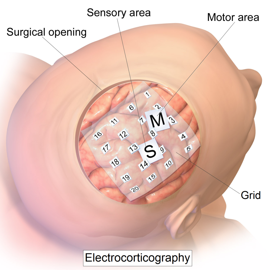 Griglia di elettrodi intercranici per elettrocorticografia, metodo di registrazione dell'attività elettrica dalla corteccia cerebrale. Credits: Blausen.com staff (2014). "Medical gallery of Blausen Medical 2014". WikiJournal of Medicine 1 (2). DOI:10.1534