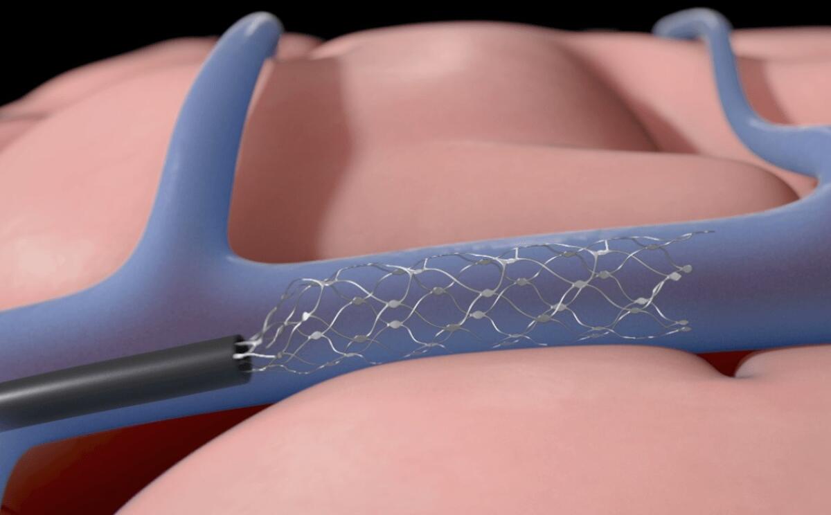 La prima interfaccia neurale endovascolare è stata impiantata nell'uomo - È stata impiantata nell'uomo la prima interfaccia neurale endovascolare. Credits: Synchron