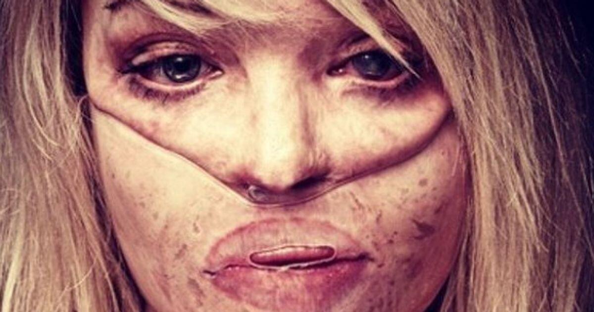 Aggressione con acido: come soccorrere la vittima? - Katie Piper, modella e conduttrice inglese, sfigurata dall'acido