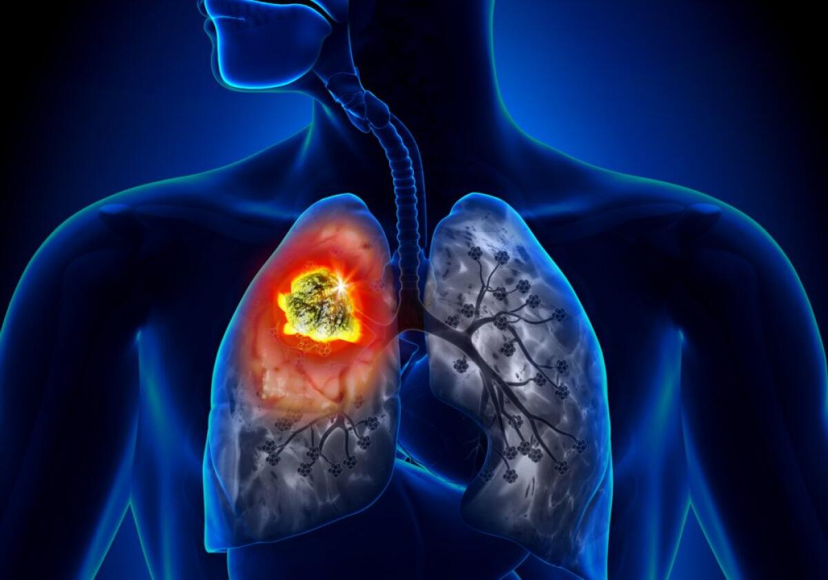 Nuovo farmaco contro il tumore ai polmoni: tasso di risposta oltre l'80% - mbamutua.org