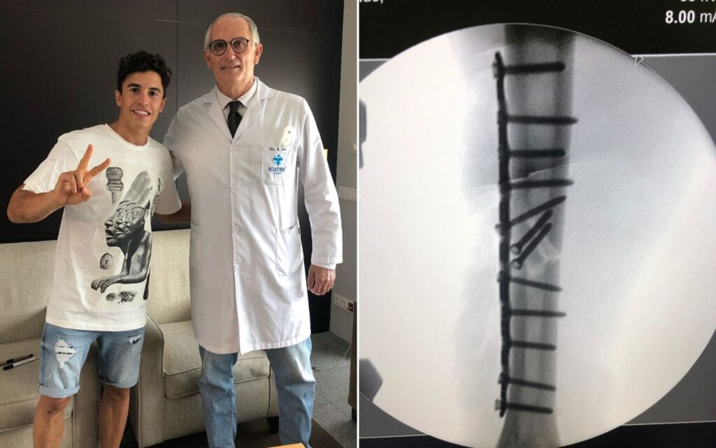 Questa foto è stata postata sul profilo instagram del pilota poco dopo la prima operazione al braccio.
