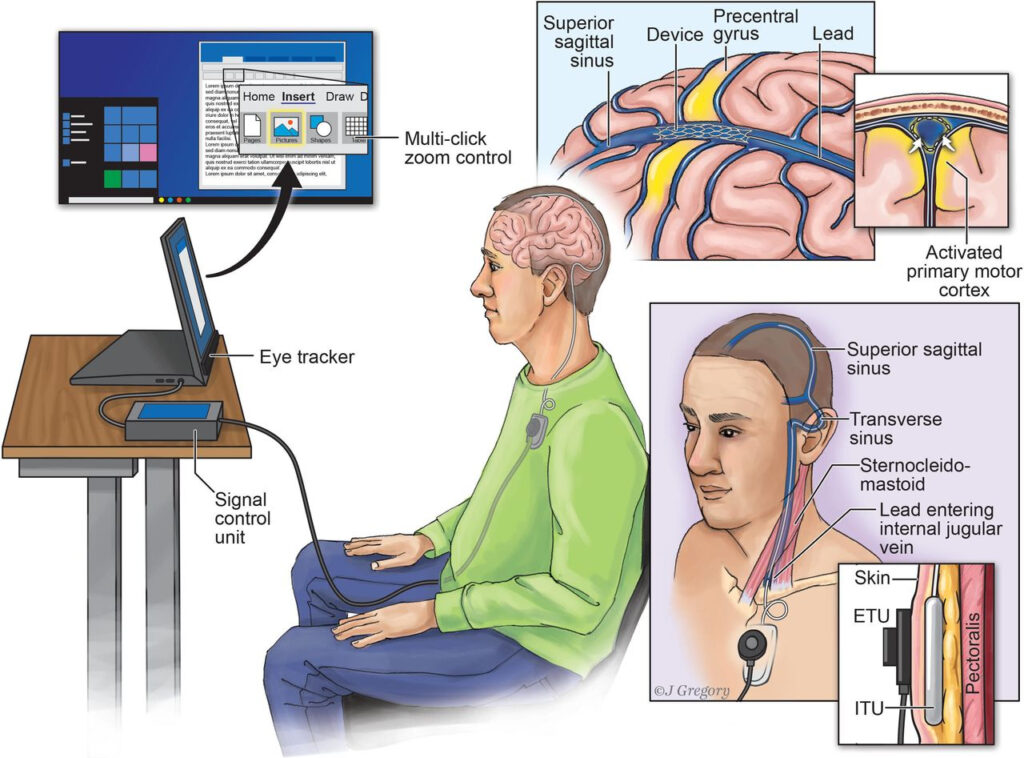 rappresentazione grafica del sistema della neuroprotesi endovascoalre. Credits: Synchron