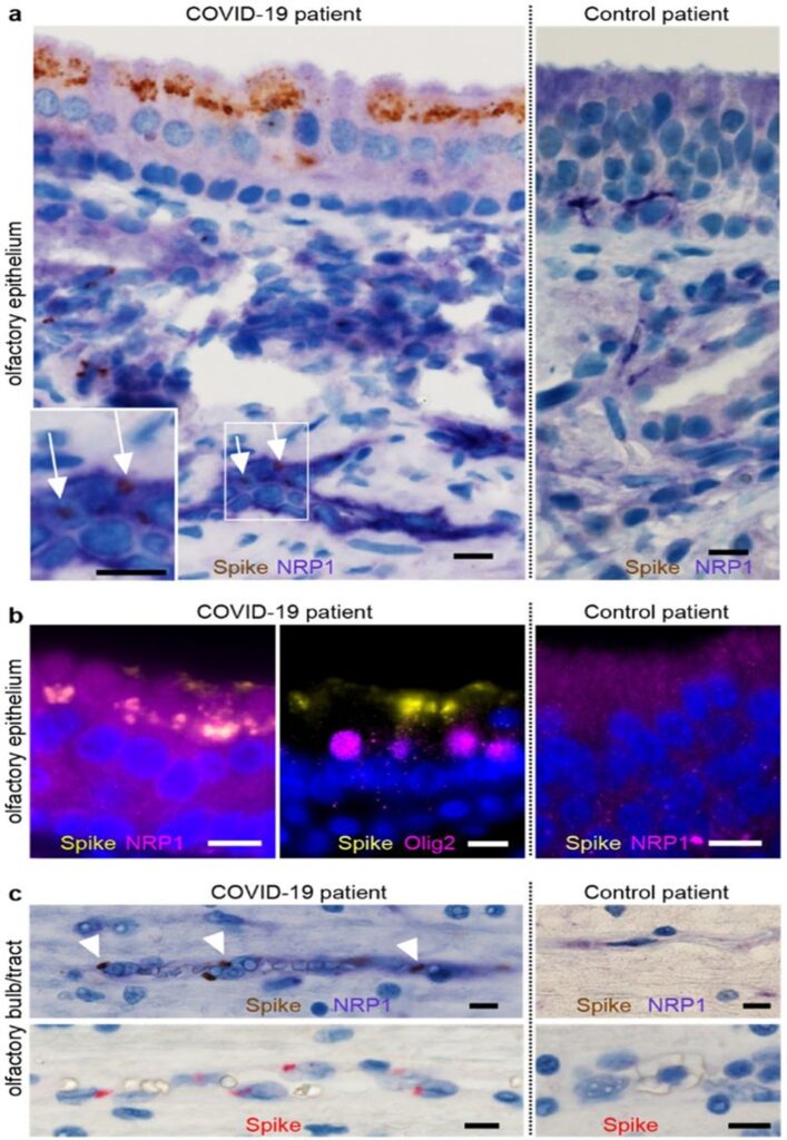 SARS-CoV-2 infetta l'epitelio olfattivo e il bulbo.credits: biorxiv.org