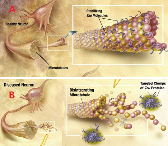 In alto l'assone di un neurone sano con i microtubuli intatti stabilizzati dalla Tau sana. In basso l'assone di un neurone malato con i microtubuli distrutti dai grovigli di proteina Tau fosforilata. Credits: MGH