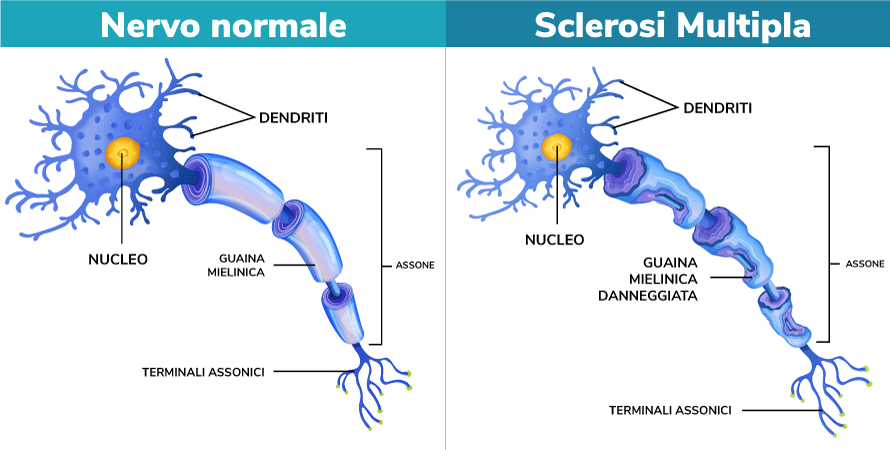 La differenza tra un nervo normale e un nervo di una persona affetta da sclerosi multipla. Credits: Creha-Riabilitazione
