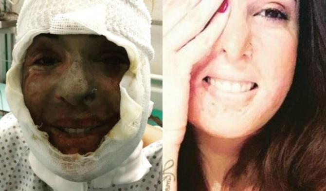 Gessica Notaro , cantante, modella e ballerina italiana, vittima nel 2017 di un'aggressione con l'acido da parte dell'ex fidanzato.credits: 105.net