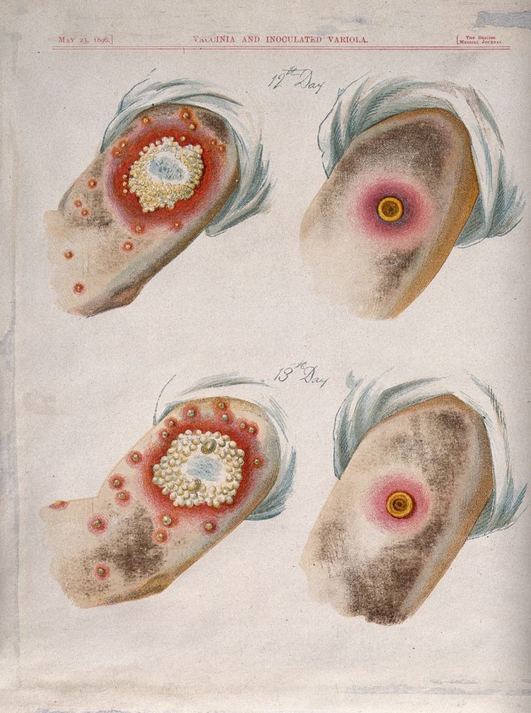 Differenza tra le pustole di vaiolo umano e vaiolo vaccino al dodicesimo e tredicesimo giorno dopo la comparsa della malattia  credits:microbiologiaitalia.it