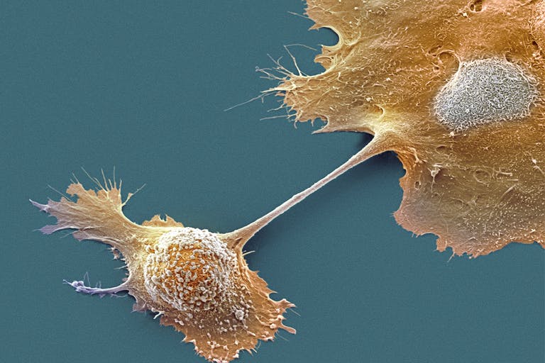 Cellule tumorali pancreatiche unite da un ponte citoplasmatico. Il cancro al pancreas spesso non causa sintomi fino a quando non è ben consolidato e non trattabile. Credits: Steve Gschmeissner / Science Photo Library