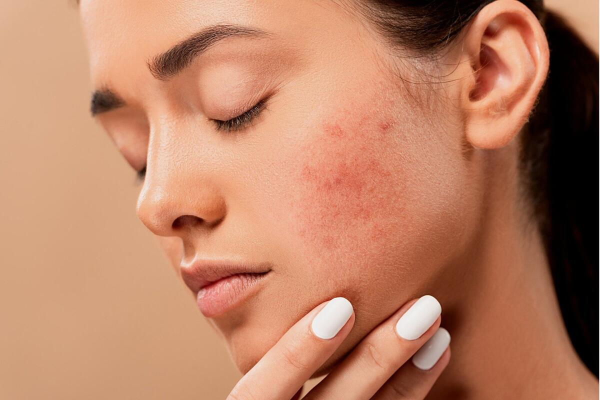 SolAcne: 5 consigli per la scelta di un prodotto idratante in caso di acne - In figura una paziente affetta da acne.