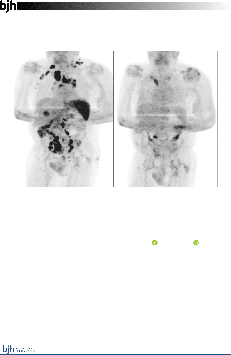 Remissione del linfoma di Hodgkin - Credits: British Journal of Haematology