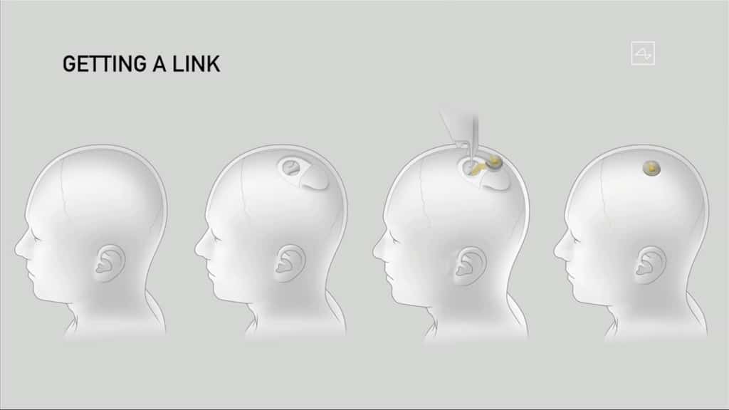 L'impianto Neuralink. Credits: Neuralink