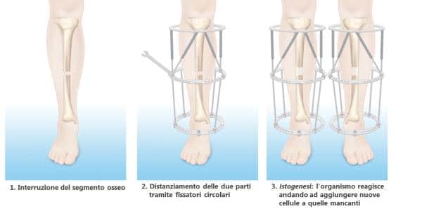 Acondroplasia e allungamento degli arti: come viene eseguito?